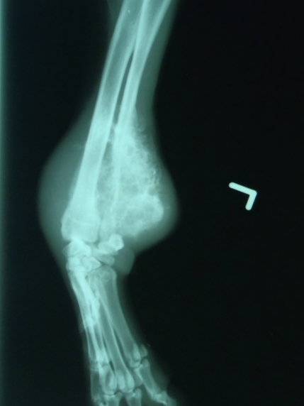 Bone Cancer of left distal ulna just above carpal joint